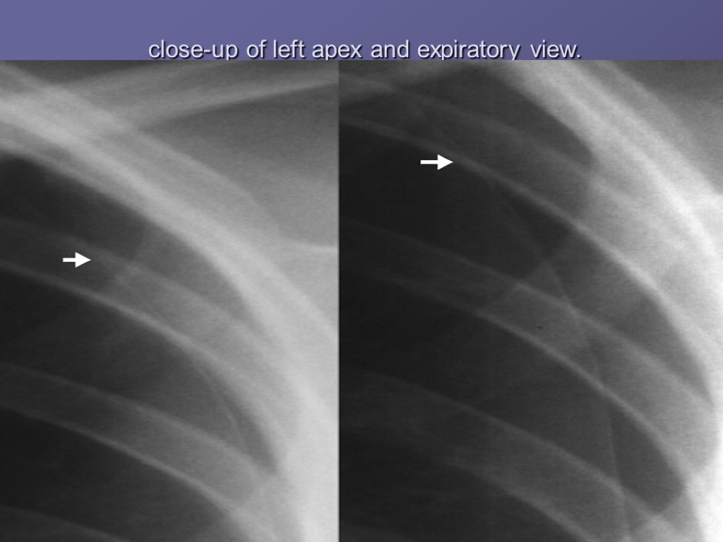 close-up of left apex and expiratory view.